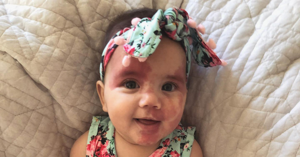 Baby med fødselsmerke