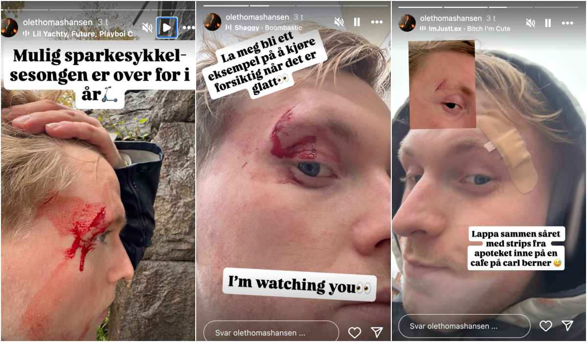 Ole-Thomas Hansen var uheldig på sparkesykkel.