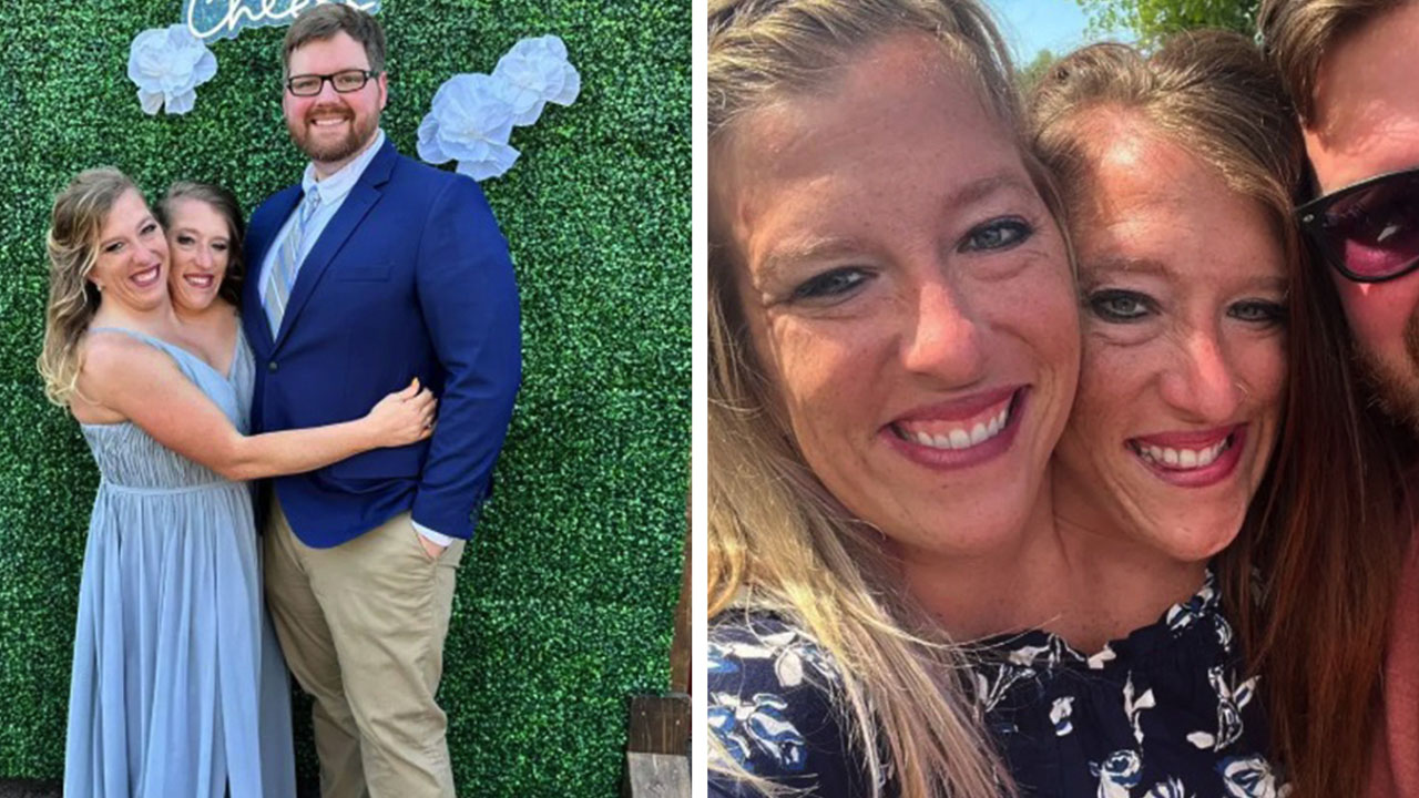 Abby Hensels ektemann, Josh Bowling, uttaler seg om de siamesiske tvillingene har fått baby.