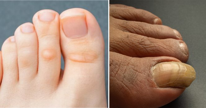 Der kan være mange årsager til tykke tånegle.