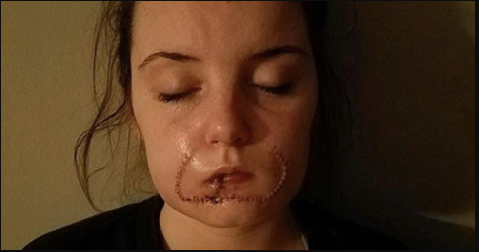 Kayla Hayes blev bidt i overlæben af sin ekskæreste.