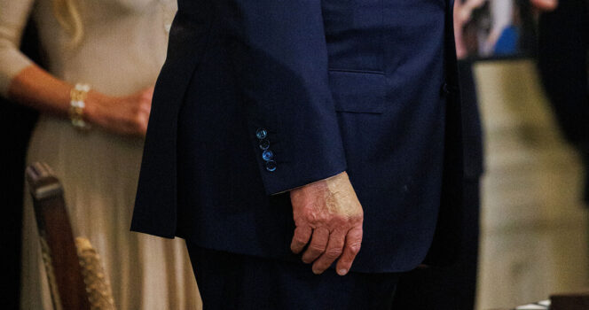 Den amerikanske præsident Donald Trumps hånd er dækket af makeup.