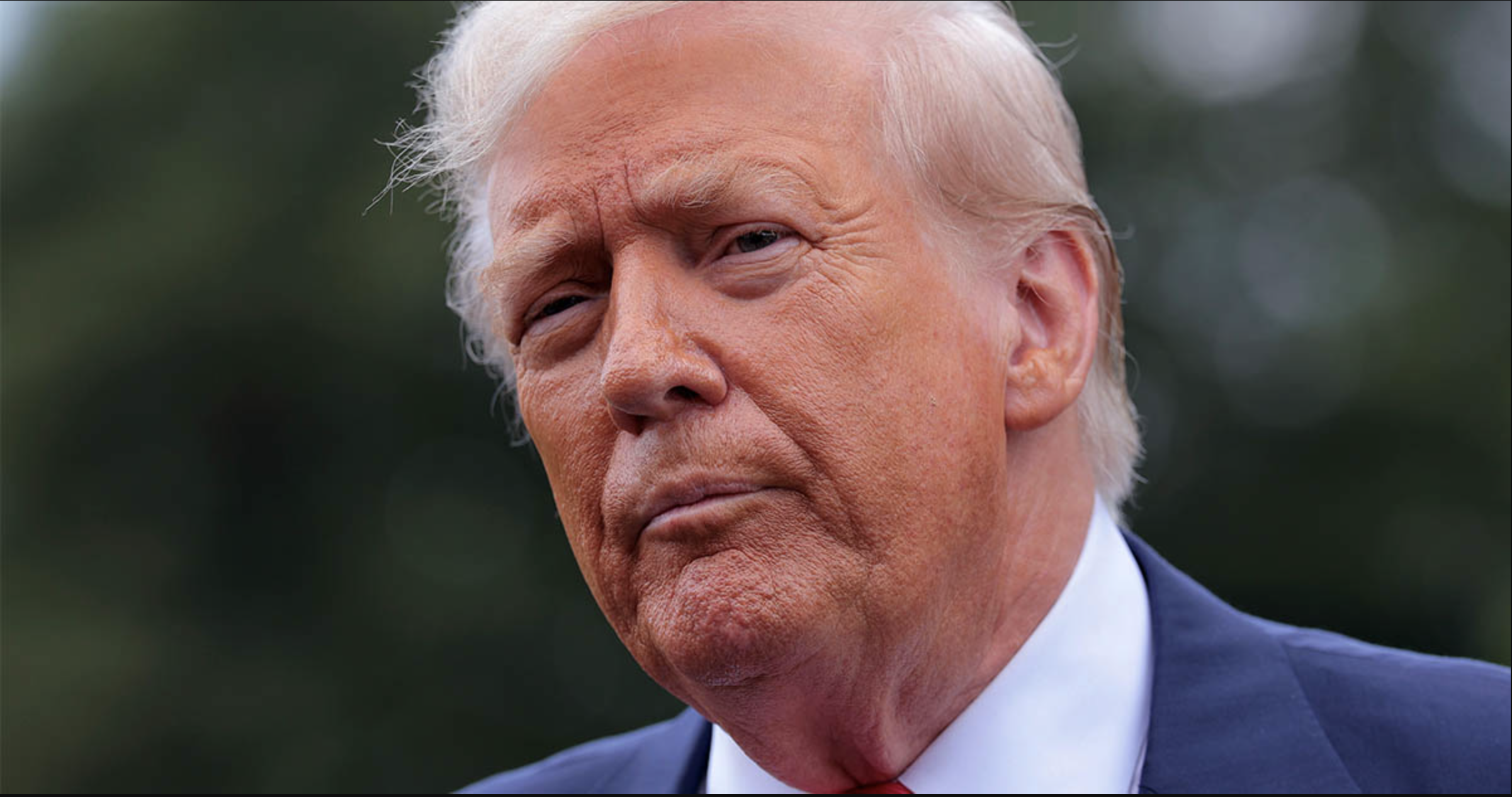 Donald Trump er diagnosticeret med kronisk venøs insufficiens.