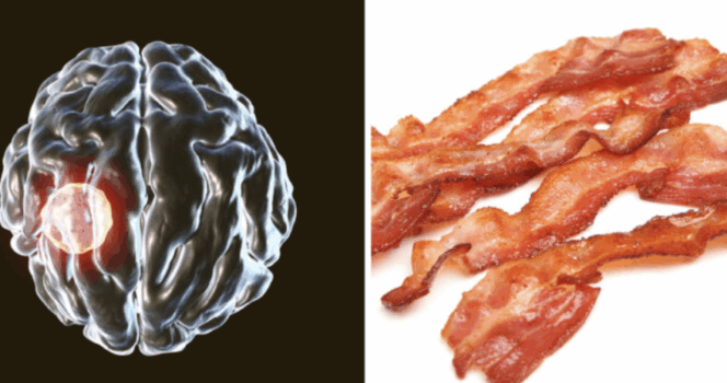 En mand har udviklet særlig orm i hjernen efter indtag af bacon.