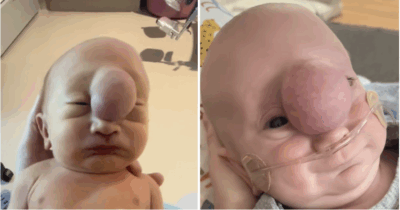 Liam blev født med en sjælden misdannelse.