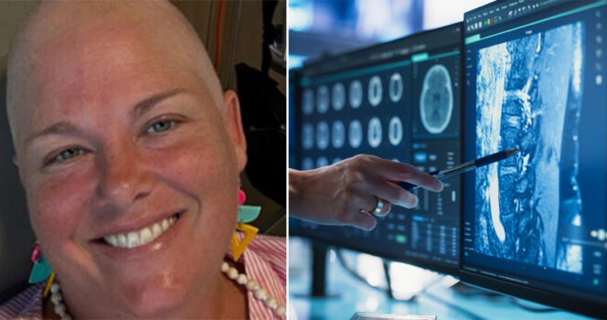 Susan Schmidt forklarer de tidlige symptomer på alvorlig kræftsygdom.