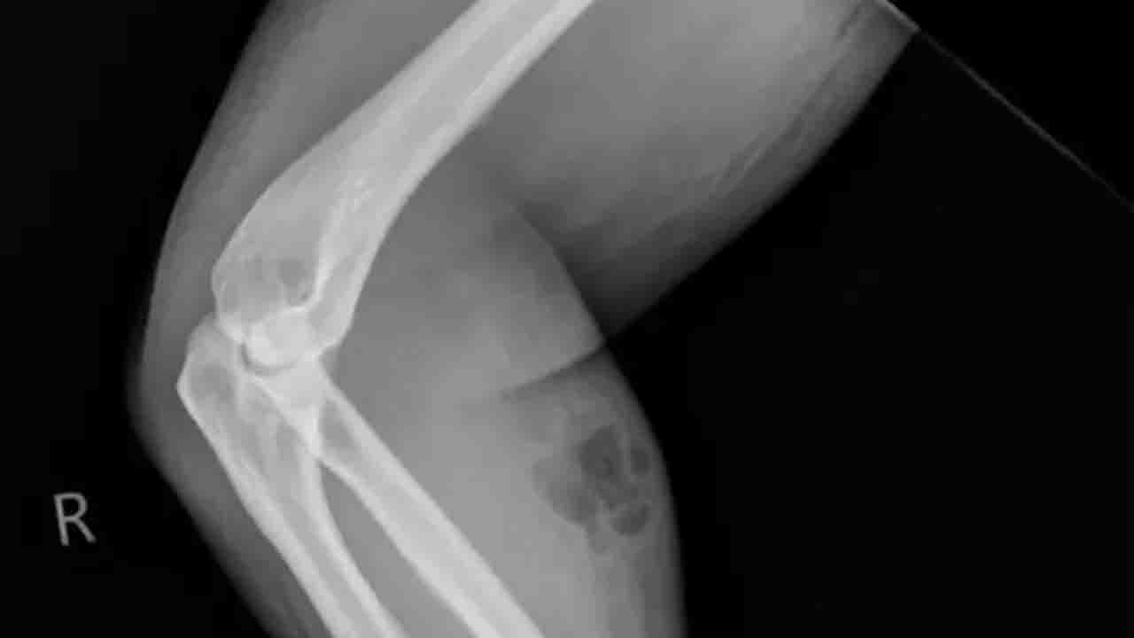 Homem se injetando com seu próprio sêmen