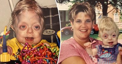 Braden West e sua mamma, nato con sindrome di Pfeiffer.