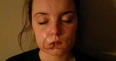 vrouw afgebeten lip