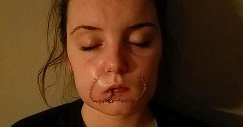 vrouw afgebeten lip