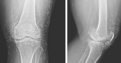 knie rontgenfoto