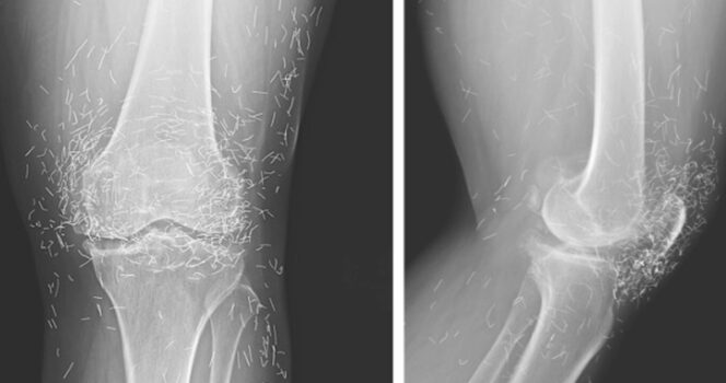 knie rontgenfoto