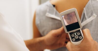moedervlek scan