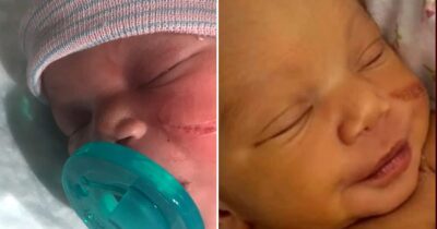 Un bébé lacéré au visage