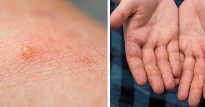Symptômes de l'eczéma dyshidrosique