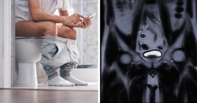 Un homme est assis sur les toilettes et une IRM de la prostate