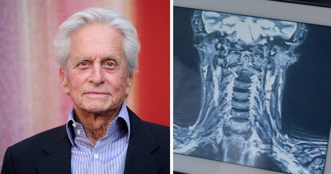 Michael Douglas et son scanner de la gorge