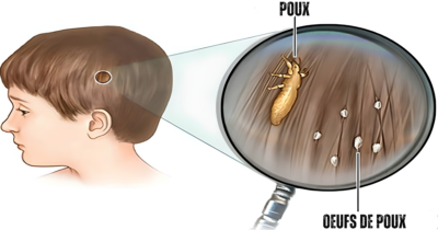 POUX